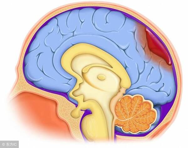 腦出血后遺癥有哪些，腦出血后遺癥的類型與表現(xiàn)