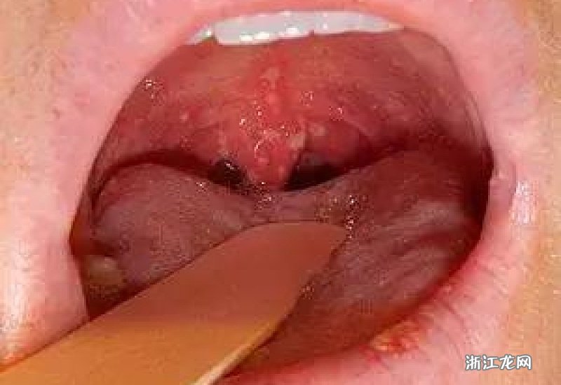 皰疹性咽峽炎五個(gè)分期詳解，皰疹性咽峽炎的五個(gè)分期詳解及特點(diǎn)解析