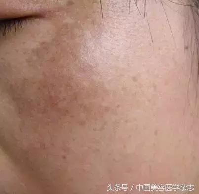 黃褐斑怎么治療最有效，全面解析最佳療法，全面解析黃褐斑最佳治療方法，最有效的療法選擇