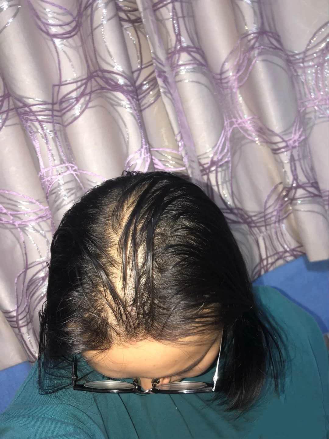 女性嚴重脫發(fā)，疾病先兆與防治策略，女性嚴重脫發(fā)，疾病預警與防治策略