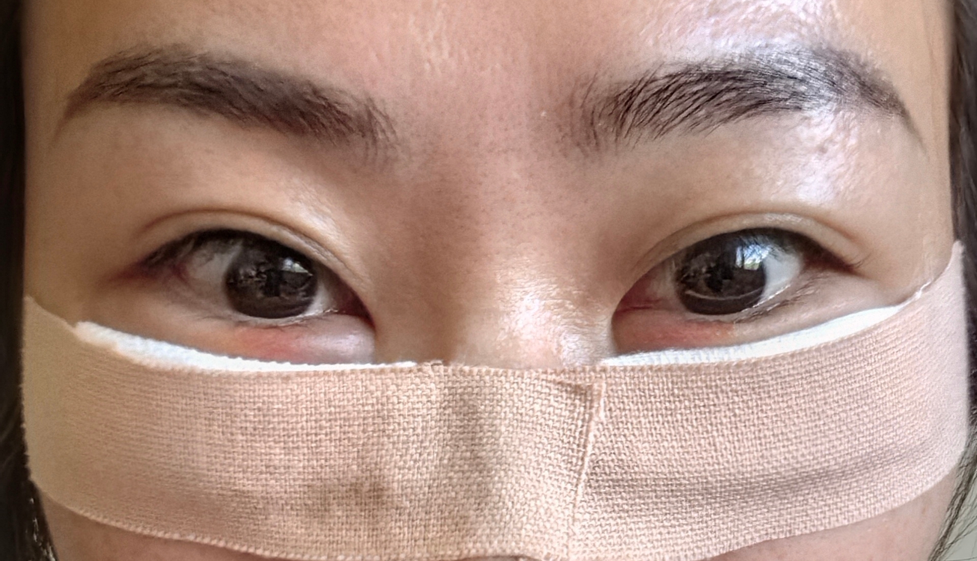 眼袋手術(shù)，重塑眼部魅力，重拾自信光彩，眼袋手術(shù)重塑眼部魅力，重拾自信亮眼光彩