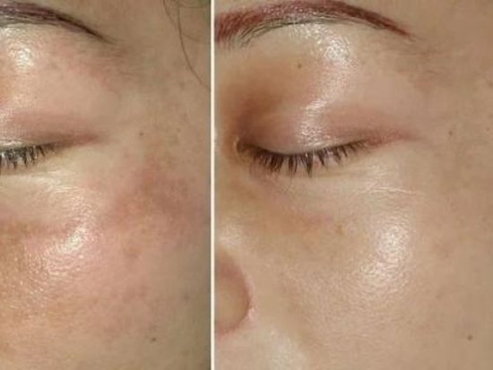 揭秘皮秒美容真相，380元一次的皮秒激光是真還是假？，皮秒美容真相揭秘，皮秒激光的真假與價格背后的秘密探究