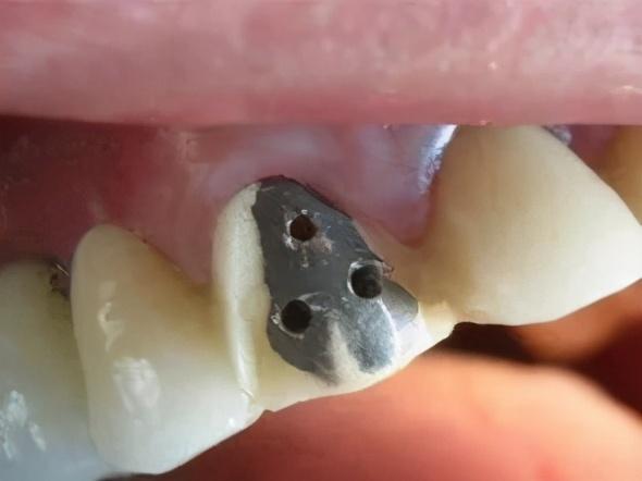 全瓷牙價(jià)格解析，多少錢一顆？，全瓷牙價(jià)格詳解，每顆價(jià)格究竟多少？