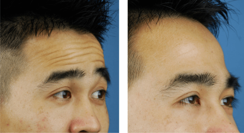 抬頭紋很重怎么去除——全面解析去除抬頭紋的方法，抬頭紋去除全攻略，有效消除頑固抬頭紋的方法