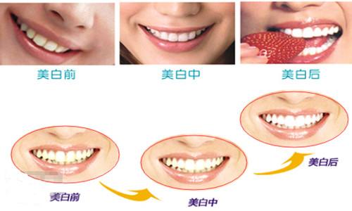讓牙齒變白的最快方法，快速美白牙齒的方法秘籍