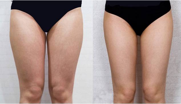 抽脂減肥反彈現(xiàn)象，原因與應(yīng)對(duì)策略，抽脂減肥反彈原因及應(yīng)對(duì)策略解析