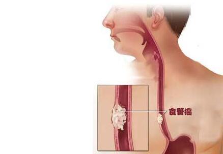 食道癌最明顯的癥狀及其影響，食道癌最明顯的癥狀及其潛在影響