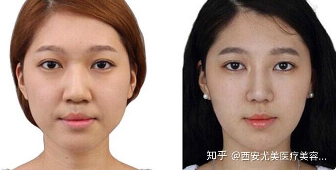 縮鼻頭手術(shù)費(fèi)用詳解，大概需要多少錢？，鼻頭縮小手術(shù)費(fèi)用全解析，了解縮鼻頭手術(shù)大概需要多少錢？