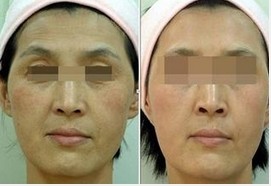 面部除皺針，價格因素與選擇指南，面部除皺針，價格因素與選擇指南詳解