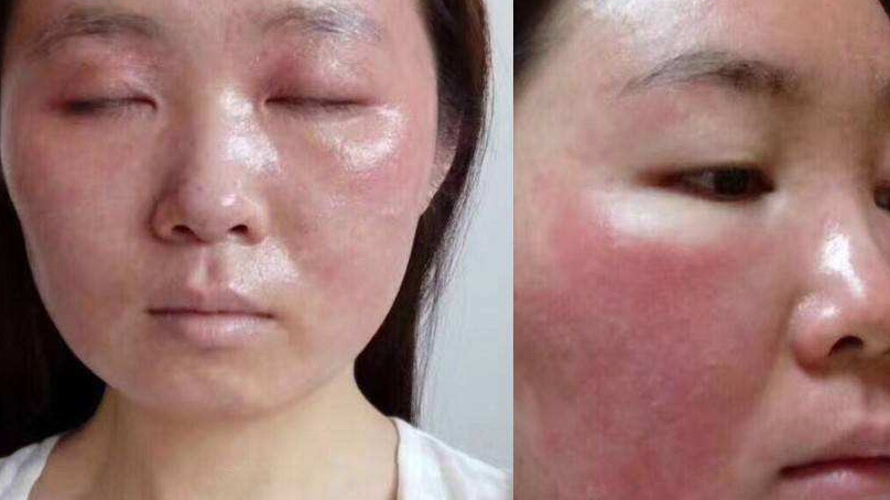 激素臉的正確修復(fù)方法，激素臉的正確修復(fù)方法與步驟