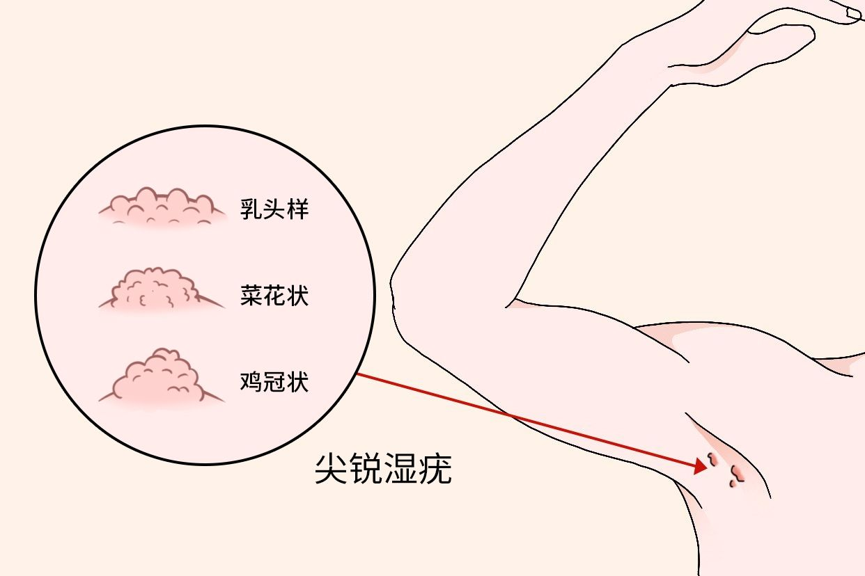 尖銳濕疣圖片，了解、識別與防治，尖銳濕疣圖片詳解，識別、防治全攻略