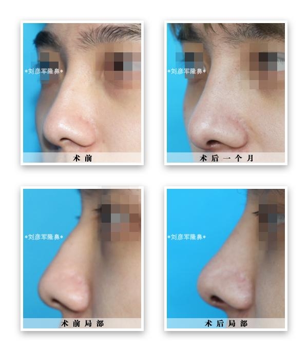 縮鼻頭，改善鼻子外觀的有效方法，縮鼻頭技巧，有效改善鼻子外觀的方法