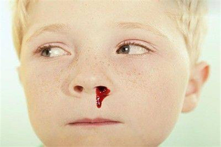 兒童白血病流鼻血的特點(diǎn)及其重要性，兒童白血病流鼻血特征與重要性解析