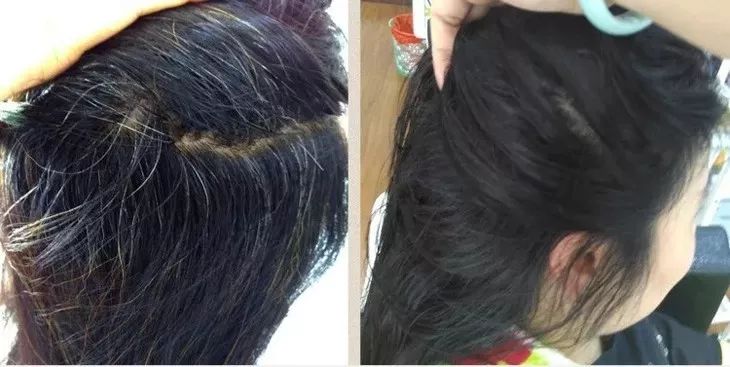 白發(fā)轉黑發(fā)，可能性與實現(xiàn)方法，白發(fā)轉黑發(fā)的可能性與實現(xiàn)方法探討