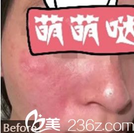 去紅血絲激光手術(shù)費用詳解，多少錢？，激光去紅血絲手術(shù)費用全面解析，費用究竟是多少？