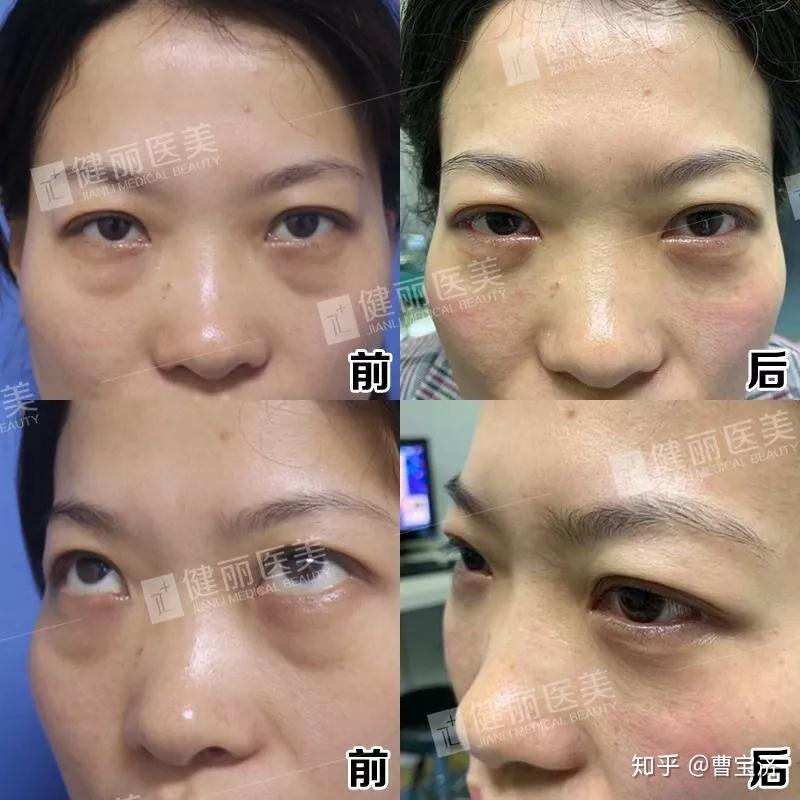 如何有效去除黑眼圈與眼袋，重塑明亮雙眼，如何消除黑眼圈與眼袋，重塑明亮雙眸的秘訣