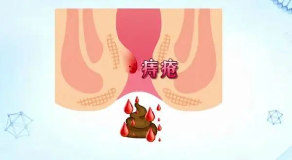 大便出血，痔瘡還是肛裂？一篇文章帶你了解，大便出血，痔瘡還是肛裂？一篇文章全面解析