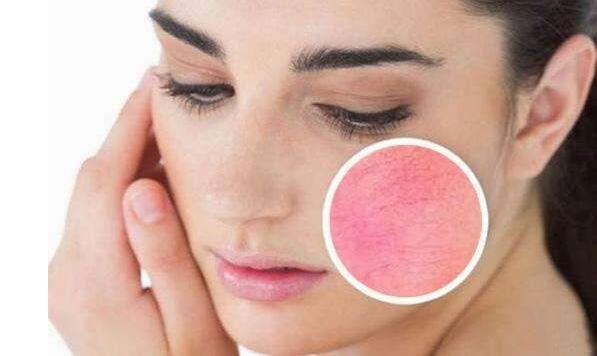 如何有效去除紅血絲，最佳方法與實用建議，紅血絲去除攻略，最佳方法與實用建議